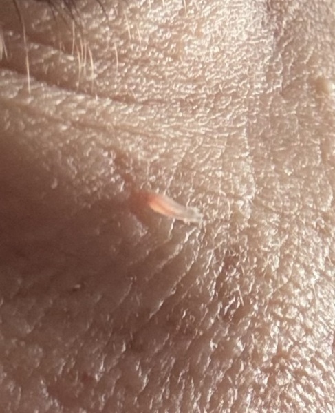 Skin tag or something else?