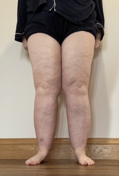 Would you say I have lipoedema?