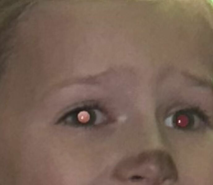AIBU? Daughter has white eye in flash photo!
