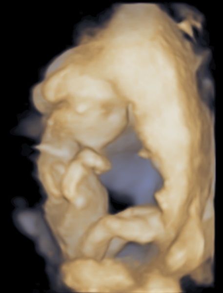 private 15 week scan- worried about spinal bifida