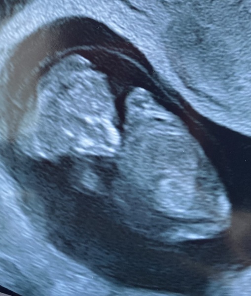 Abnormal head shape at 10 weeks gestation