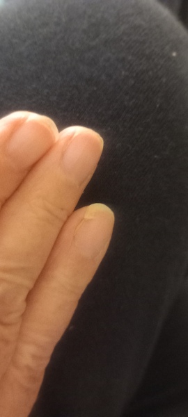 Nail split across nail bed. Anyway to fix it?