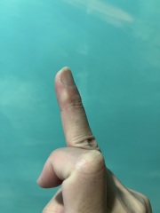 Boiling Water Blister And Medical Advice?