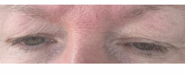 I’m thinking of blepharoplasty.