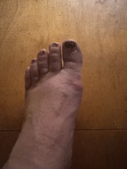 How the hell to cope with bunions?!
