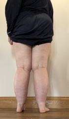 Would you say I have lipoedema?