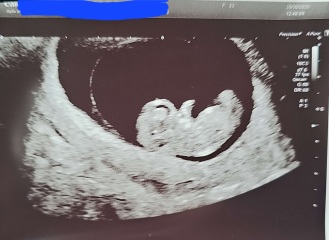10 weeks 2 days scan - Skull/Ramzi theory