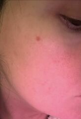 Are there any dermatologists here that can help please?