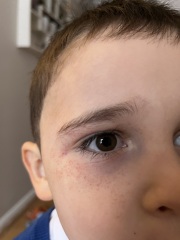 Son has a small rash that keeps coming up on face