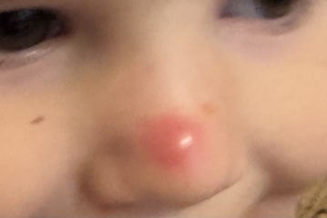 Lump on child’s nose