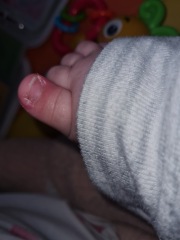 Baby with ingrown toenails? Anyone else?