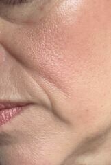 What to about these jowls?