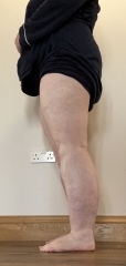 Would you say I have lipoedema?