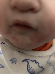 Is this teething rash?