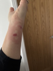 Tick bite?? Does any one have any idea what type of bites these are??