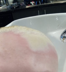 Daughter in hospital - full thickness burns
