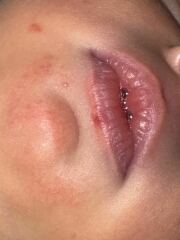 Bump on 7 day old daughters lip