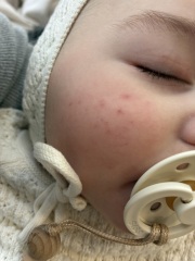Infantile Acne/Baby Acne at 5months
