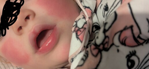 Slapped cheek or allergy?
