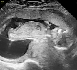 private 15 week scan- worried about spinal bifida