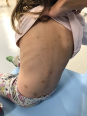 Is this a concerning amount of bruises?