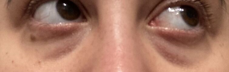 Tear trough filler, whats your experience?