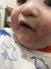Is this teething rash?