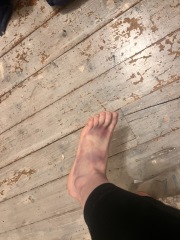 I’ve done something to my foot. Am I just overreacting to a bruise