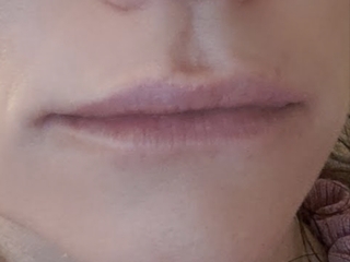 Do You Have Lip Fillers?