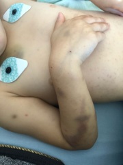 Is this a concerning amount of bruises?