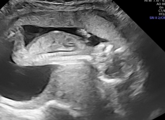 private 15 week scan- worried about spinal bifida
