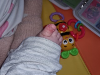 Baby with ingrown toenails? Anyone else?