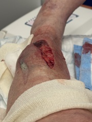 Thread #6, living with incurable cancer, taking ALL the drugs, and remembering our fallen comrades