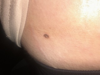 Moles or skin tag