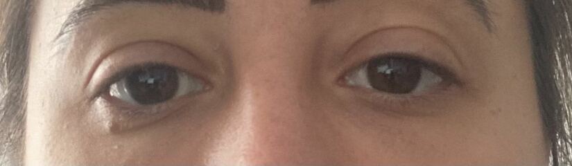 Tear trough filler, whats your experience?