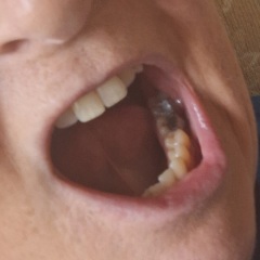 Waiting in the dentist for a filling