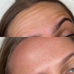 Recommendations for Botox / fillers in Manchester area please