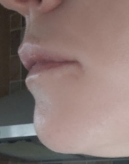 Do You Have Lip Fillers?
