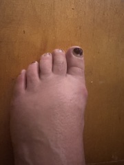 How the hell to cope with bunions?!
