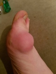 How the hell to cope with bunions?!