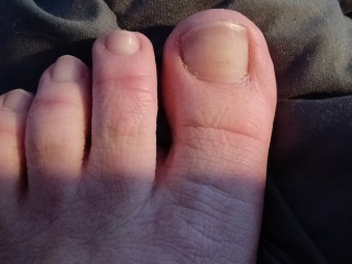 Worrisome toenails(both big toes)