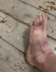 I’ve done something to my foot. Am I just overreacting to a bruise