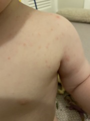 Chickenpox?