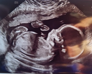 20 week gender scan