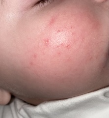 Infantile Acne/Baby Acne at 5months