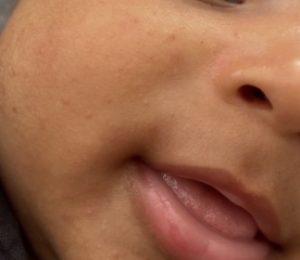 Baby skin rash/spots 3 months