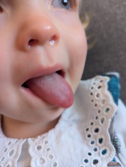 Could this be strawberry tongue?