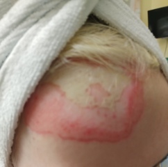 Daughter in hospital - full thickness burns