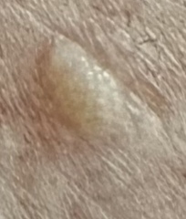 Blister looking growth on chest. Advice please