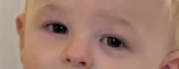 Random bruise under baby’s eye